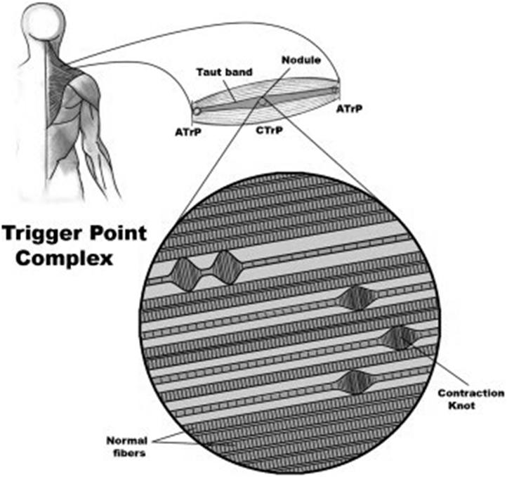 Myofascial trigger points (MTrPs) Hyperirritable spots in taut bands of skeletal muscle Painful on compression, gives rise to referred pain Always tender Weaken the muscle Mediate a local twitch