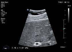 Shear wave elastography ElastPQ uses ultrasound shear wave elastography to provide a non-invasive, reproducible, and easily performed method of assessing tissue stiffness.