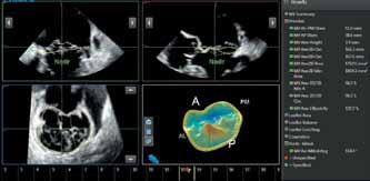 Automatic registration for image fusion and navigation CT and ultrasound vessel and surface registration allow you to complete the challenging task of registering a CT volume with ultrasound in less