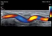 The next generation of Color Flow Imaging Ulnar artery Common femoral