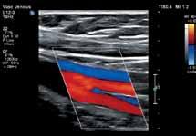 incorporates new color Doppler technology that increases flow resolution,