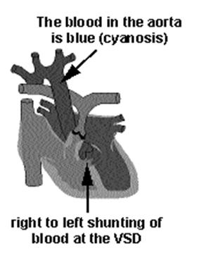 Tetralogy of Fallot MOST COMMON CYANOTIC HEART DISEASE Includes 4