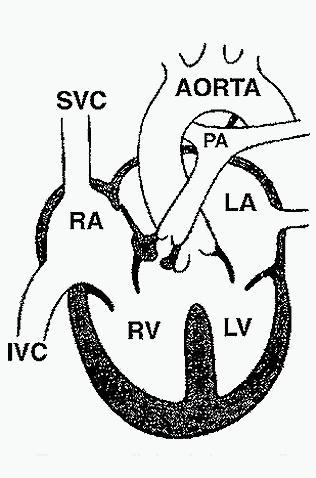 Cyanotic Congenital Heart Disease 26 This diagram depicts the features of Tetralogy of Fallot:1. Ventricular septal defect; 2. Overriding aorta; 3. Pulmonic stenosis; 4. Right ventricular hypertrophy.