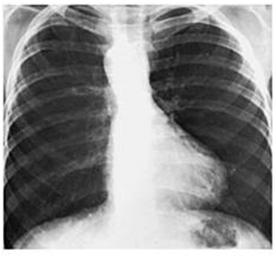 Treat CHF Prostin Surgical Blalock Taussig Shunt: subclavian to pulmonary