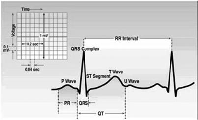 Common Electrolyte Disturbances Hyperkalemia= peaked T waves, widened QRS Hypokalemia prominent U waves Hypercalcemia= short Qt interval Hypocalcemia= prolonged Qt interval Dysrhythmias Brady