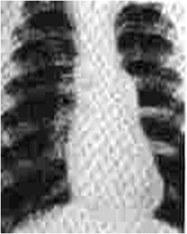 Lesions Obstructing Blood Flow Pulmonary Stenosis Pulmonary Stenosis (PS) Aortic Stenosis (AS) Coarctation of the Aorta (CoAo) Obstruction of blood flow to pulmonary bed May be valvular (90%),
