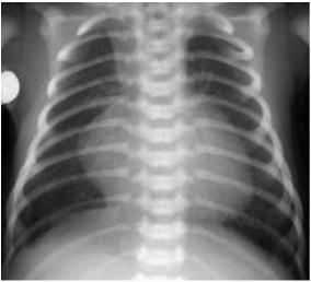 CXR Most common cyanotic lesion in NEWBORN period Ebsteins Anomaly Single Ventricle Pulmonary