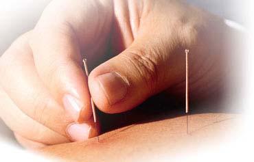 Acupuncture in America Today Licenses & Laws As of 2005, there were 22,671 Licensed Acupuncturists in the United States 41 States and