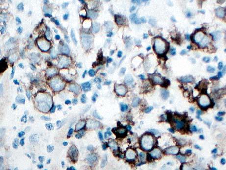 CD123 HLA-DR TCL1 Blastic plasmacytoid dendritic cell