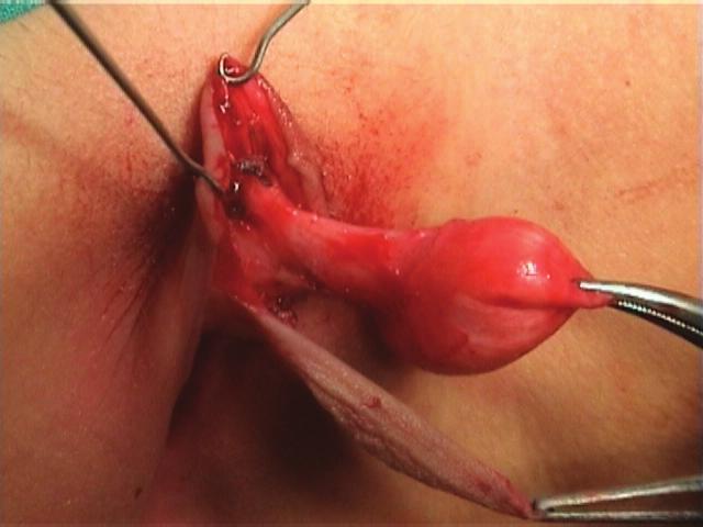 Circumcised female with clitoral cyst. Fig. 2(b).