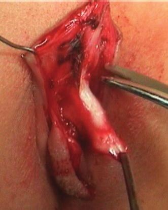 Clitorolabial Reconstruction in Circumcised Females 67 flap which was