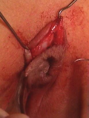 Clitoral cyst excised leaving clean clitoral stump.