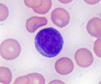 A mature lymphocyte (blue/purple cell) surrounded by several mature red blood cells An immature lymphocyte called a
