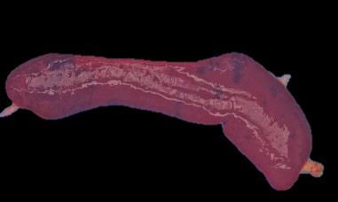 Lymphoid Tissue Lymph nodes