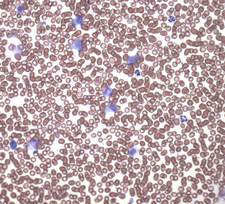 leukemia = Neoplastic lymphocytes in bone