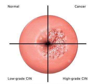 5/3/17 Cervical Lesions HPV Pathogenesis may be