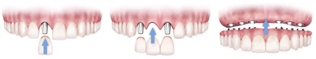 TYPES OF IMPLANT TREATMENT Because dental implants can be used throughout the mouth, they make it possible to restore as few or as many teeth as necessary.