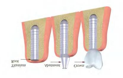 What pieces make up Dental implants? Dental implants typically have three parts: 1. The implant: A medical grade titanium screw that serves as a root for your new teeth.