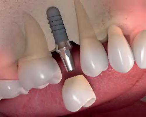 What are Single Tooth Implants? Are you missing a single tooth?