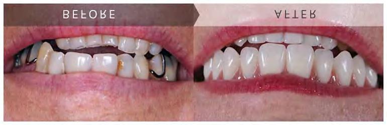 What results can I expect? Have a look at some before and after results with the same day smile procedure to see what you could achieve at The Berkeley Implant Centre.