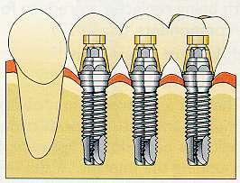 implants for