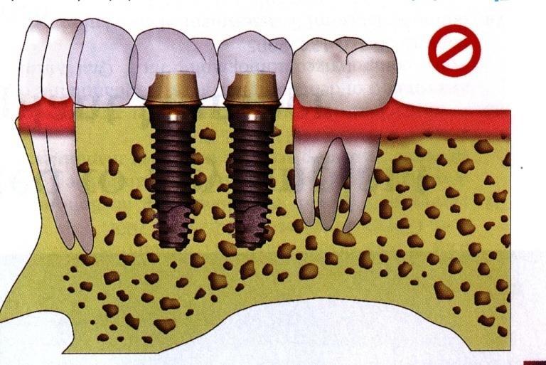Partial tooth loss IMPLANT THERAPY: