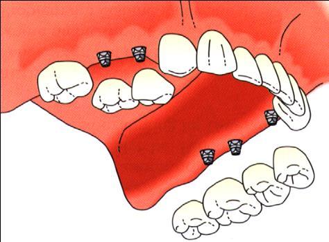 Orthodontic treatment: