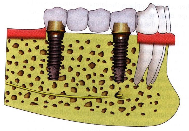 Partial tooth loss IMPLANT THERAPY: