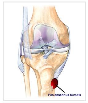 Cushioned knee brace/pad Aspirate/injection Pes Anserine Bursitis Easy