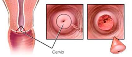 CIN, some management notes CIN is asymptomatic and comes to clinical attention through an abnormal Pap smear result Followed up by colposcopy, during which