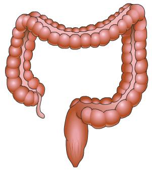 But Esophagus ulcerative colitis usually only affects the colon. This reference summary explains the causes, symptoms, diagnosis, and treatment of ulcerative colitis.