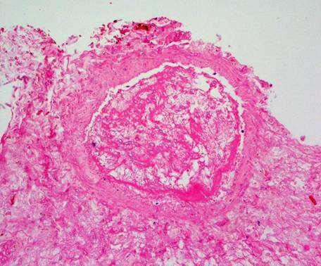 Fungal colitis Typically