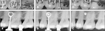 The IPT in the mandible was significantly higher in the failure group than in the