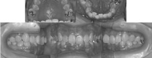 The mesial movement of the anchor teeth was rather caused by a slight deformation of the long arms of the transpalatal bars between the implant and the