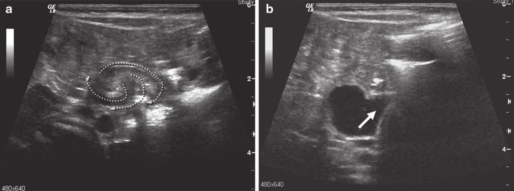 376 F.I. Luks Fig. 48.4 Ultrasonographic signs of midgut volvulus. Top: swirling pattern of the superior mesenteric vessels due to volvulus of the mesentery.