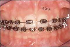 bonded tube of regular size on teeth.