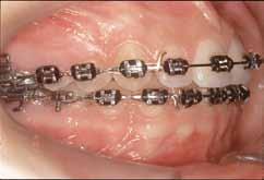 orthodontic treatment, mainly in deep overbite cases.