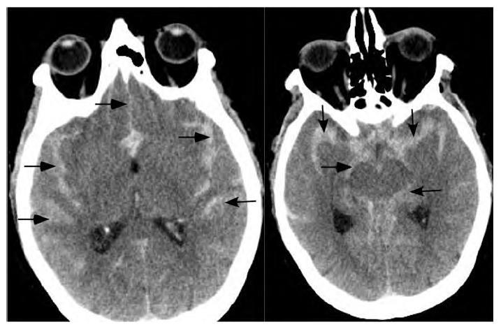 Axial CT demonstrates high-density fluid layering along the bilateral cortical sulci,