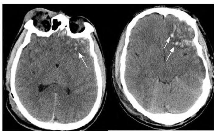 Focal punctate areas of high density (white arrows) in the bilateral inferior frontal lobes and left temporal