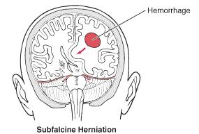 Subfalcine herniation.