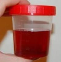 Nervousness Black urine Alkaptonurea inborn error of metabolism (tyrosine