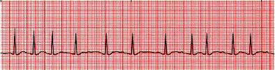 Atrial Fibrillation Rhythm: Rate: P wave: PR Interval: QRS: T wave: QT: