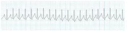 Supraventricular Tachycardia Rhythm: Rate: P wave: PR Interval:
