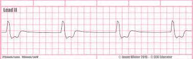 Idioventricular Rhythm Rhythm: Rate: P wave: PR Interval: QRS: T wave: