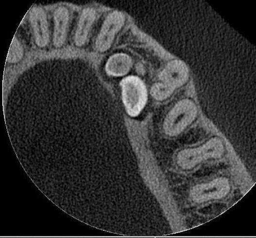 Orthopantomography showed a canine impaction caused by the presence of a conglomerate of dental-like radiopaque formations, delimited by a narrow radiotransparent area, with the characteristics