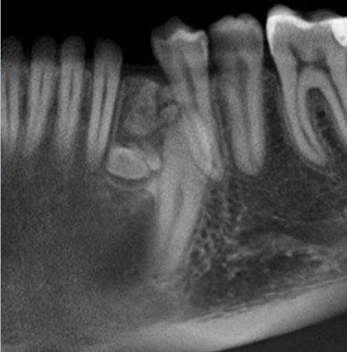 - CBCT- sagittal view of the compound odontoma Fig. 1.