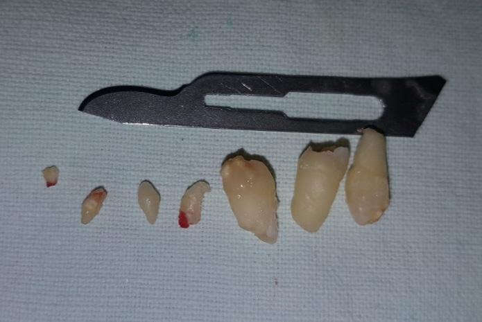 6,7), braces application for traction on the dental arch could not be performed in the same session and the orthodontist planned a second session.