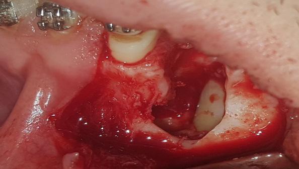 the left upper vestibule. The patient declared no systemic pathology associated. Intraoral examination (Figs.