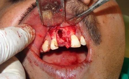 The extracted tooth and masses were sent for pathological examination. Healing of the area was uneventful, and one week after the surgery, the sutures were removed.