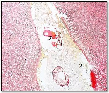 Fig. 16: Van gieson stain under 100X: 1.dentin, 2.collagen (case 2).